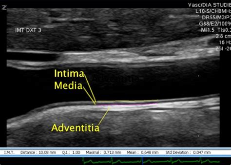 intima-media thickness measurement|intimal thickening carotid ultrasound.